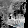 Рентген лицевого скелета
