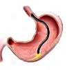 Эндоскопическое удаление полипа желудка