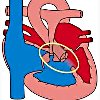 Коррекция атрезии легочной артерии