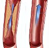 Ангиопластика внутренней сонной артерии